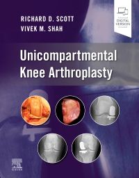 Unicompartmental Knee Arthroplasty